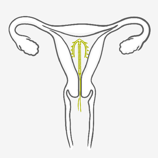 Dispositivo Intrauterino – DIU – Cómo usarlo Dispositivo Intrauterino – DIU – Cómo usarlo