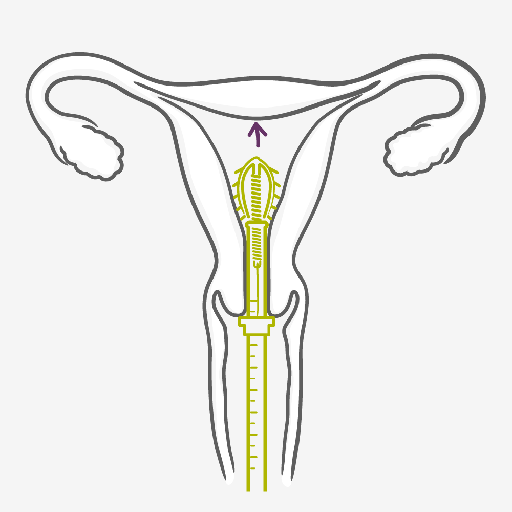 Cómo usar el Dispositivo Intrauterino – DIU Cómo usar el Dispositivo Intrauterino – DIU