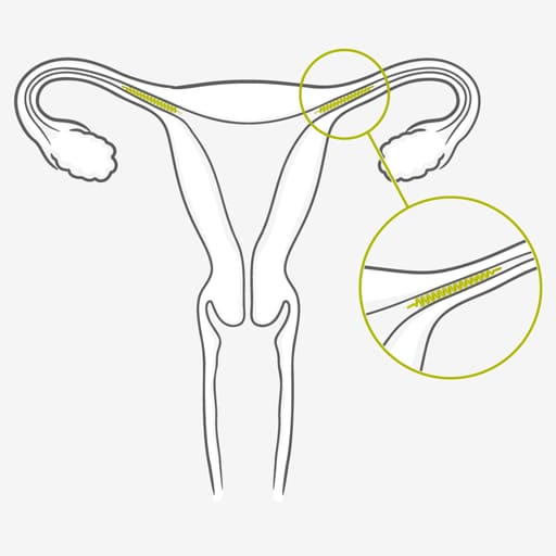 Esterilización Esterilización