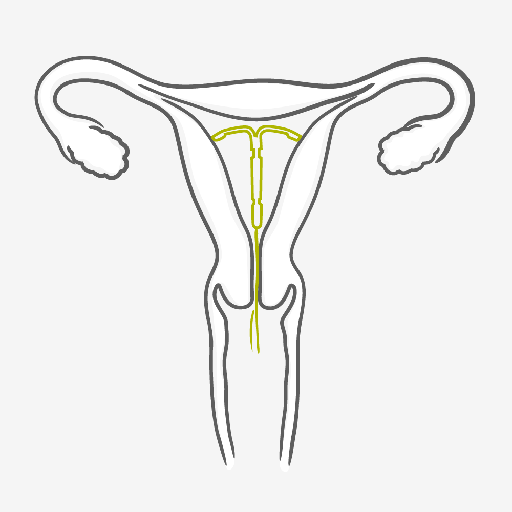 IUS placed into uterus IUS placed into uterus