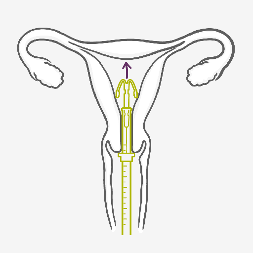 IUS inserted