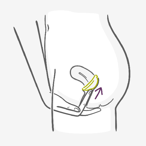 Fold the diaphragm in half and slide it up into your vagina Fold the diaphragm in half and slide it up into your vagina